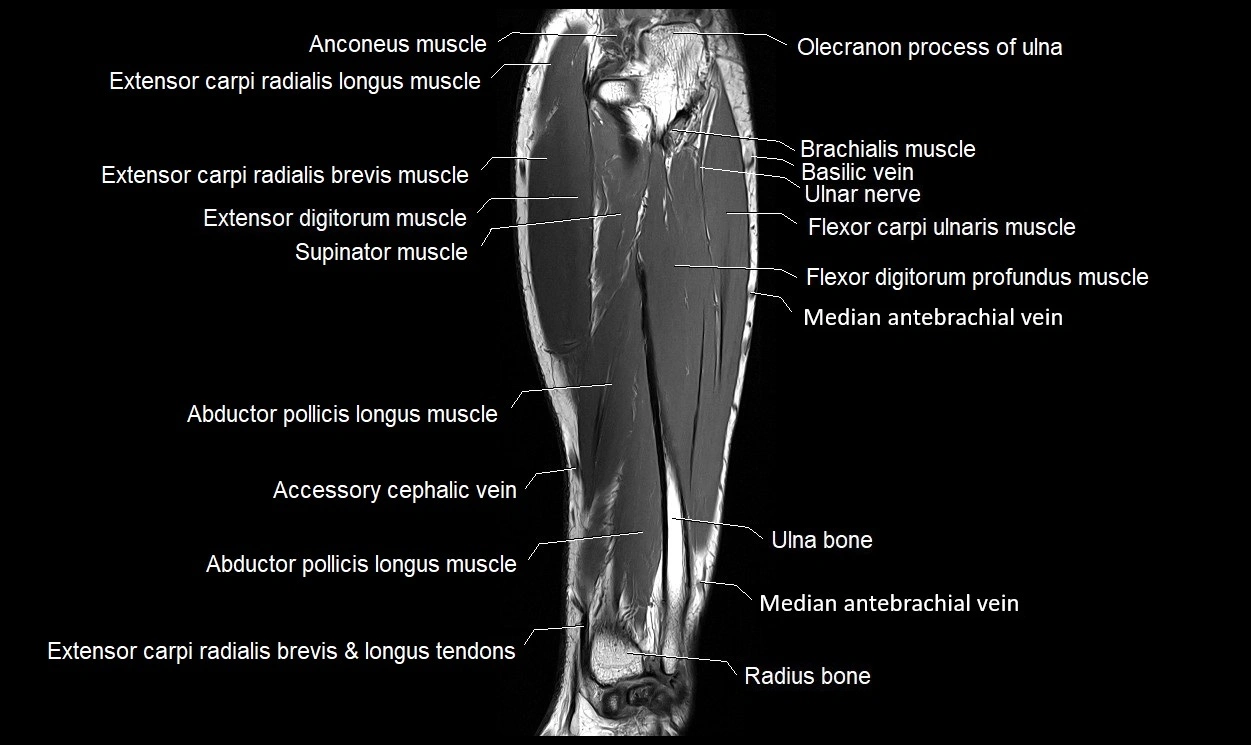 MRI 3T forearm coronal cross sectional anatomy image 19.webp